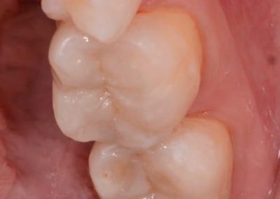 Estetická výplň - zub po ošetření
