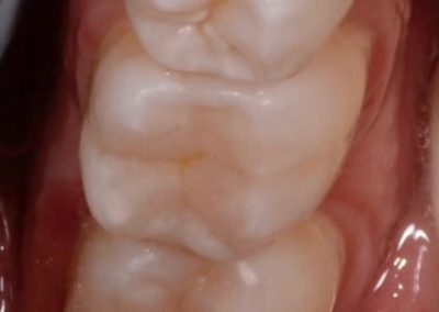 Nevyhovující výplň a kaz - zuby po ošetření