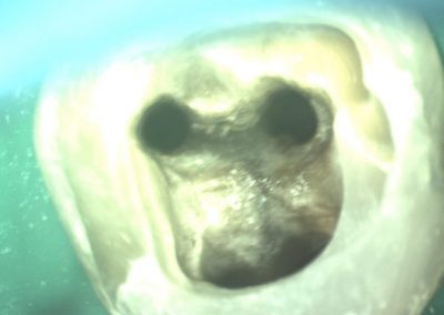 Mikroskopická endodoncie - ošetření kanálků