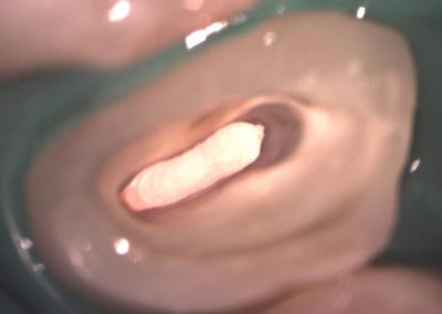 Mikroskopická endodoncie - ošetření kanálků
