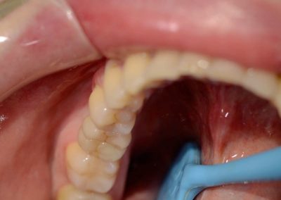 zubní implantáty