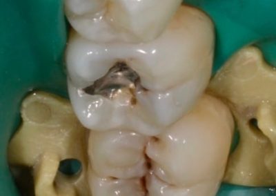 Nevyhovující výplň a kaz - zuby před ošetřením