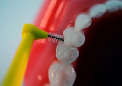 dentalní hygiena - čištění mezer zubu